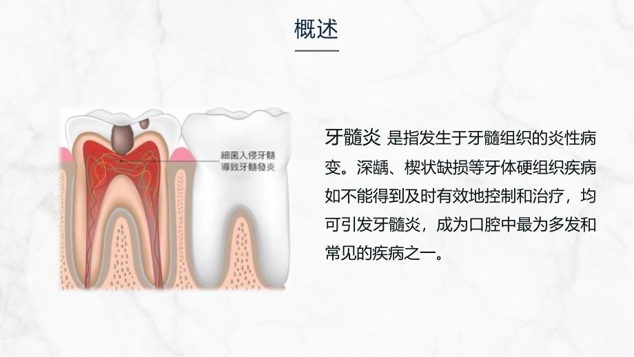 牙髓炎的护理查房 (2)_第4页